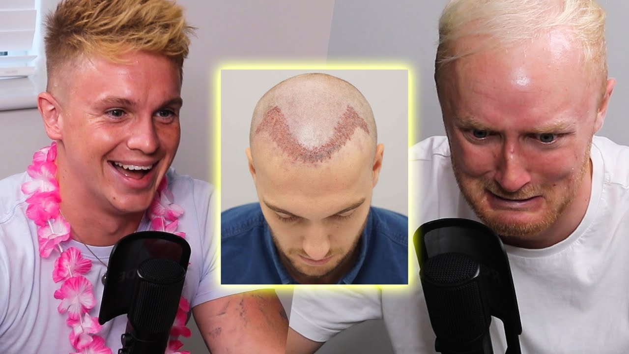 Theo Baker Hair Transplant: A Journey to Confidence 1 Theo Baker Hair Transplant: A Journey to Confidence
