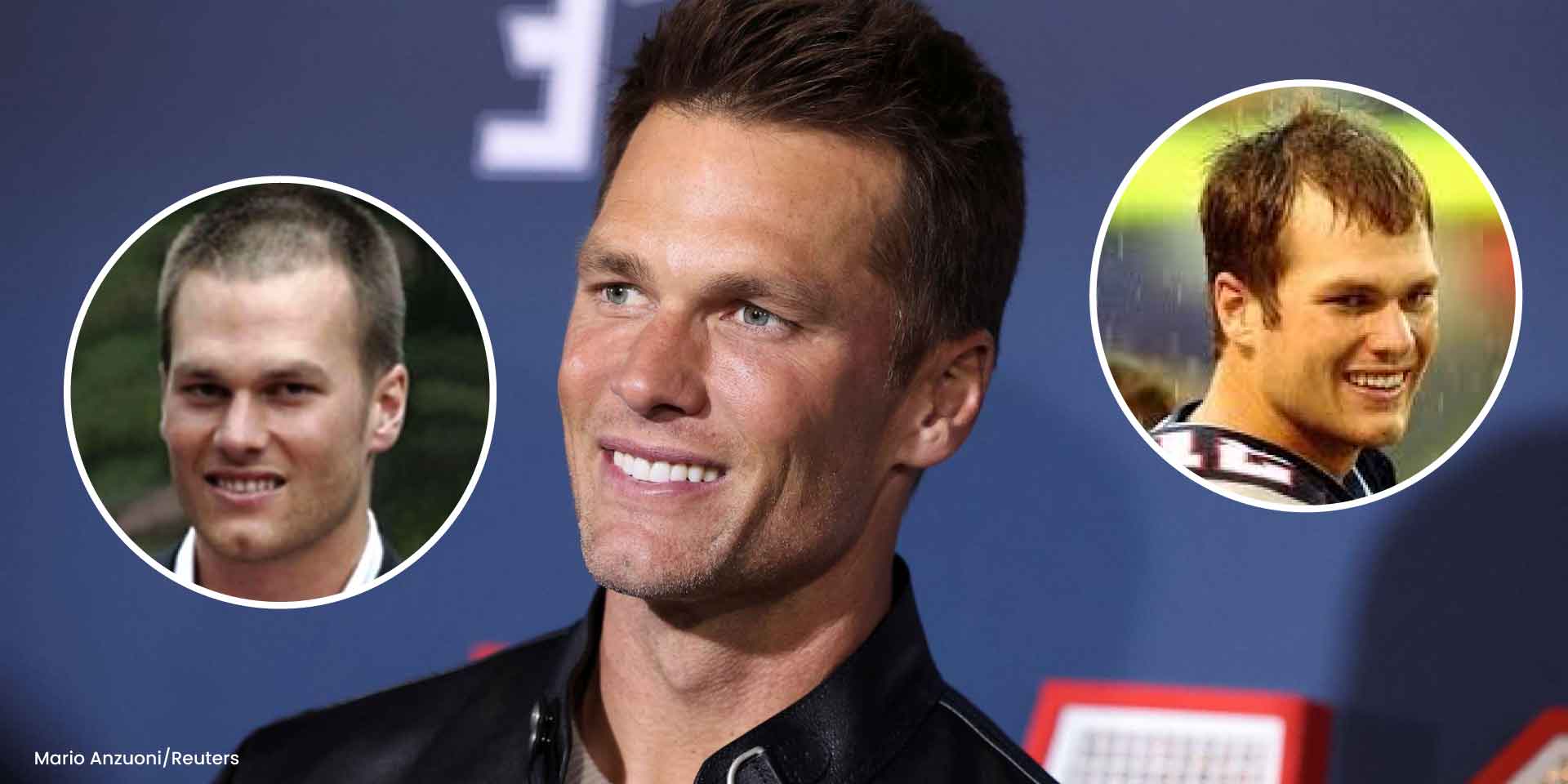 Tom Brady and Hair Transplants: The Truth Behind the NFL Icon’s Hair Transformation 1 Tom Brady and Hair Transplants