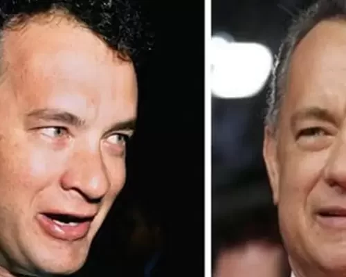 Tom Hanks Hair Transplant: Did the Hollywood Icon Opt for Hair Restoration?