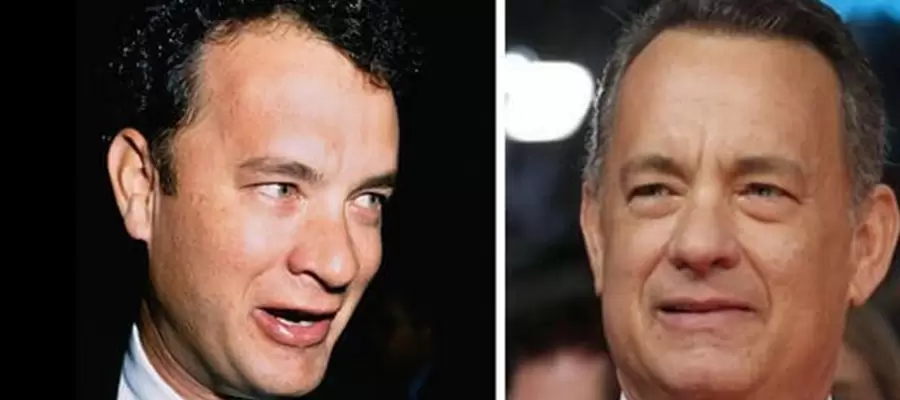 Tom Hanks Hair Transplant: Did the Hollywood Icon Opt for Hair Restoration? 1 Tom Hanks Hair Transplant: Did the Hollywood Icon Opt for Hair Restoration?