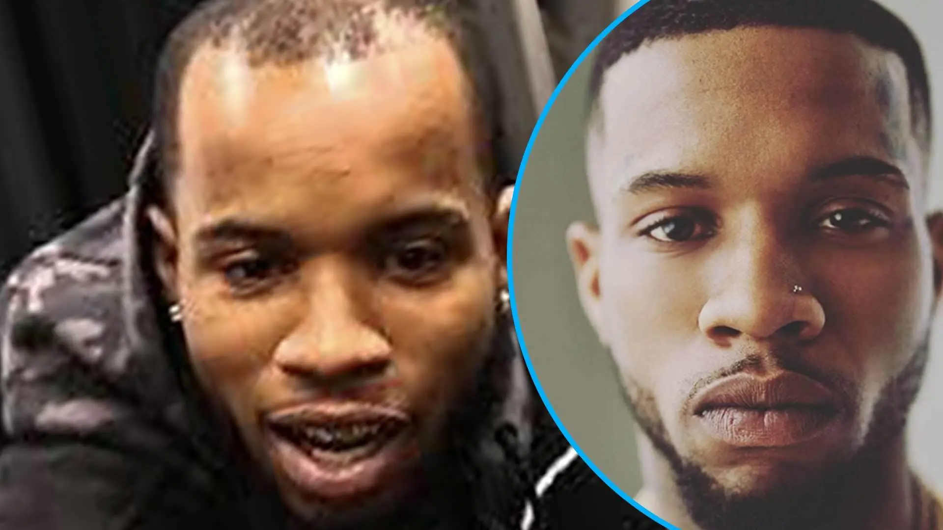 Tory Lanez Hair Transplant: The Journey to Restored Confidence 1 Tory Lanez Hair Transplant