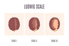 Understanding the Ludwig Scale: Female Baldness Patterns Explained