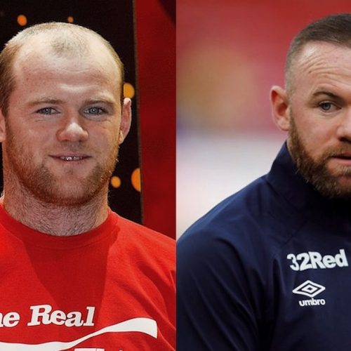 Wayne Rooney Hair Transplant: A Trailblazer in Men’s Hair Restoration