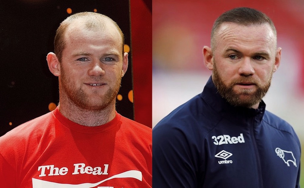 Wayne Rooney Hair Transplant A Trailblazer In Men s Hair Restoration wayne-rooney-hair-transplant-a-trailblazer-in-men-s-hair-restoration