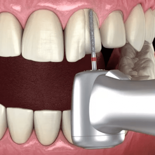 What Is Teeth Shaving and Who Might Need It?