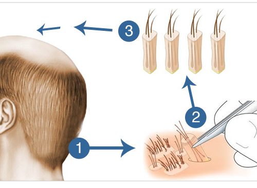 What Is the Overharvested Donor Area in Hair Transplant?