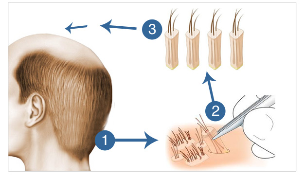 What Is the Overharvested Donor Area in Hair Transplant? 1 What Is the Overharvested Donor Area in Hair Transplant?