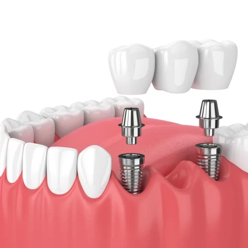 What Is a Dental Bridge? Types, Benefits & Process