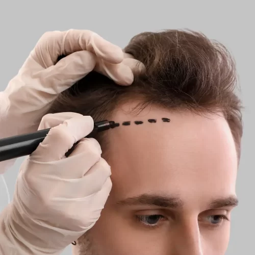 What Is a Hair Graft? A Comprehensive Guide