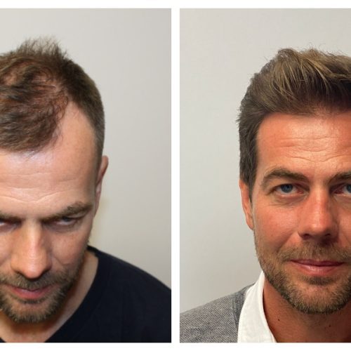 What to Do Before Hair Transplant Surgery: A Comprehensive Guide