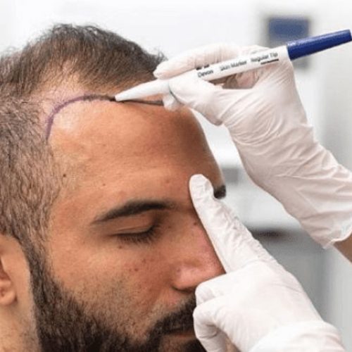 Which Is the Best Country for Hair Transplant? A Comprehensive Guide