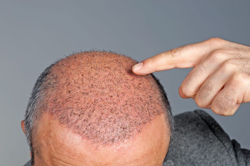 why-do-hair-transplants-fail