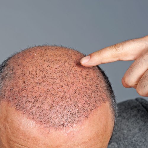 Why Do Hair Transplants Fail?