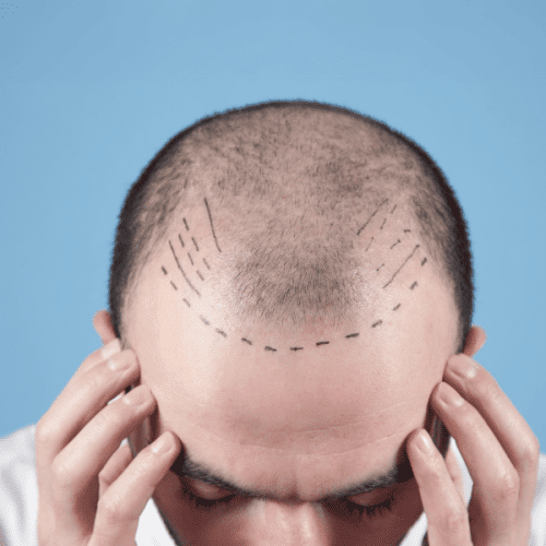 Why Turkey is Famous for Hair Transplant?