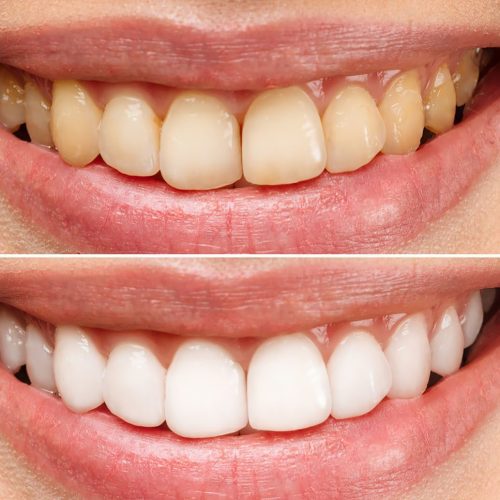 Yellow Teeth: 4 Effective Home Remedies to Whiten Your Smile