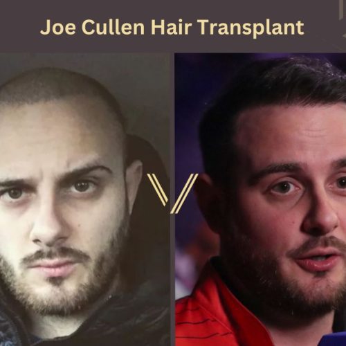 Joe Cullen Hair Transplant: A Transformation That Inspires Confidence