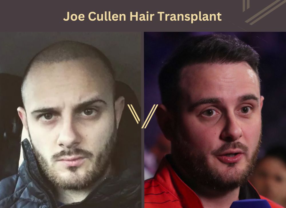 Joe Cullen Hair Transplant: A Transformation That Inspires Confidence 1 Joe Cullen Hair Transplant: A Transformation That Inspires Confidence