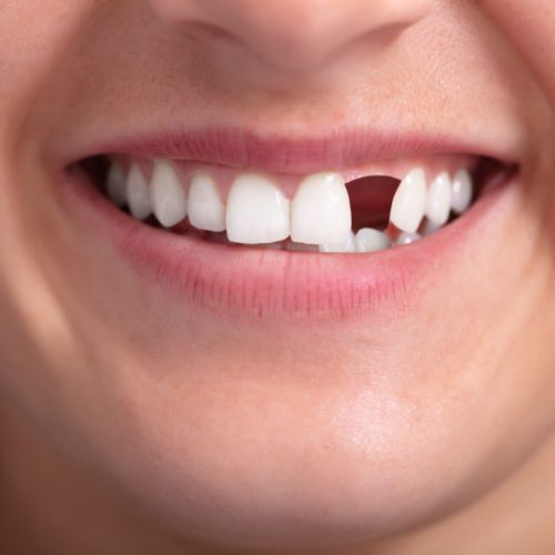 4 Causes of Tooth Loss and How to Prevent It