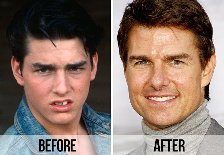 6 Celebrities Who Got Veneers: Before and After Transformations 1 When it comes to Hollywood smiles, it’s no secret that many celebrities rely on cosmetic dentistry to perfect their pearly whites. Veneers, thin shells of porcelain or composite resin bonded to the front of the teeth, are a popular choice for achieving a flawless smile. Let’s take a closer look at six celebrities who underwent incredible transformations with veneers.