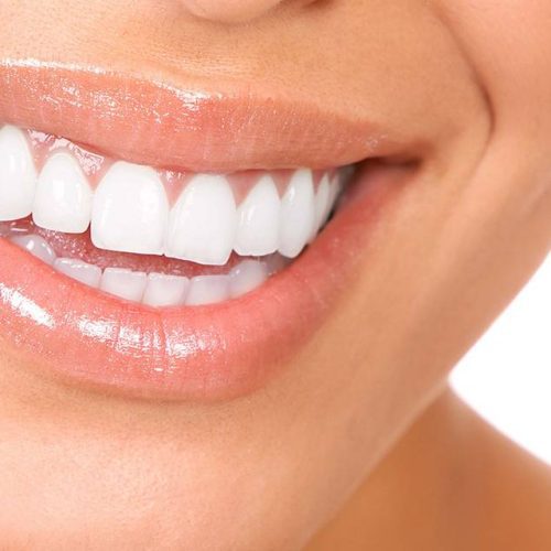 7 Surprising Facts About Dental Veneers You Might Not Know