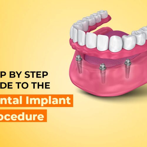 A Comprehensive Guide to the Dental Implant Procedure: Step-by-Step Breakdown