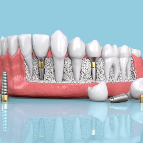 Affordable All on 6 Dental Implants: The Ultimate Guide to Tooth Replacement