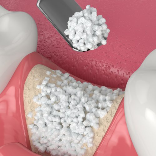 All You Need to Know About Dental Bone Grafts