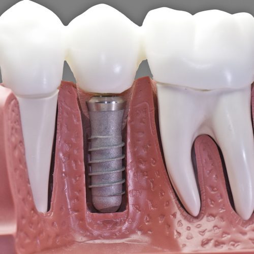 An In-Depth Guide to Obtaining Dental Implants in Turkey