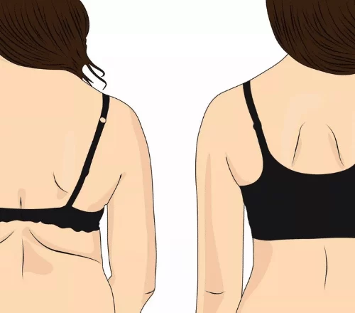 Back Lift Surgery: Understanding Upper Back Lift, Bra-Line Back Lift, and Lower Back Lift