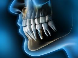 Can You Get Dental Implants with Bone Loss?