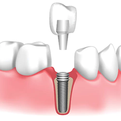 a dental implant and a human teeth