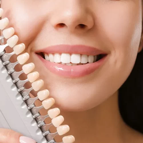 Clip-On Veneers: Essential Information to Consider Before Getting Them