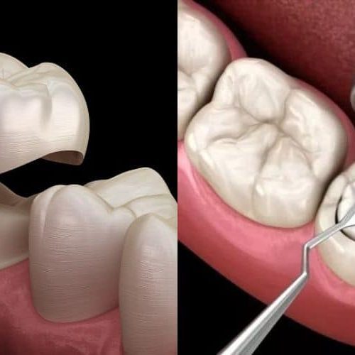 Crowns vs. Fillings: Key Similarities and Differences