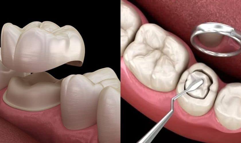 Crowns vs. Fillings: Key Similarities and Differences 1 Crowns vs. Fillings: Key Similarities and Differences