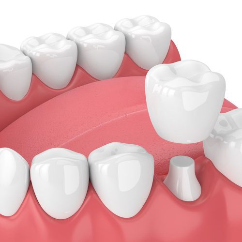 Dental crowns are a common dental solution for restoring the functionality and aesthetics of a damaged tooth. However, like all dental work, crowns are not immune to wear and tear, and sometimes they may require repair. Understanding the procedure and associated costs can help you make informed decisions about your dental health.