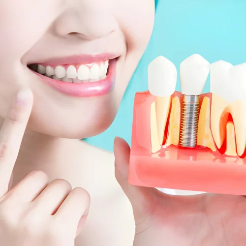 Dental Implants for Front Teeth: Costs, Benefits, and What to Expect