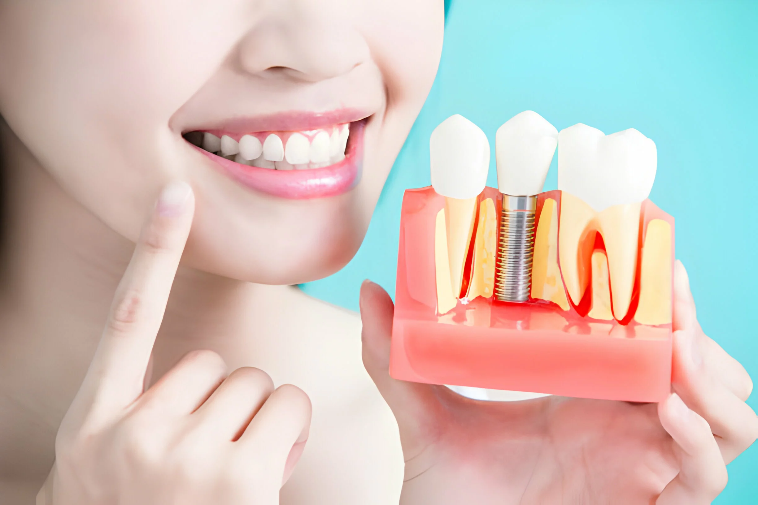 Dental Implants for Front Teeth: Costs, Benefits, and What to Expect 1 Dental Implants for Front Teeth: Costs, Benefits, and What to Expect