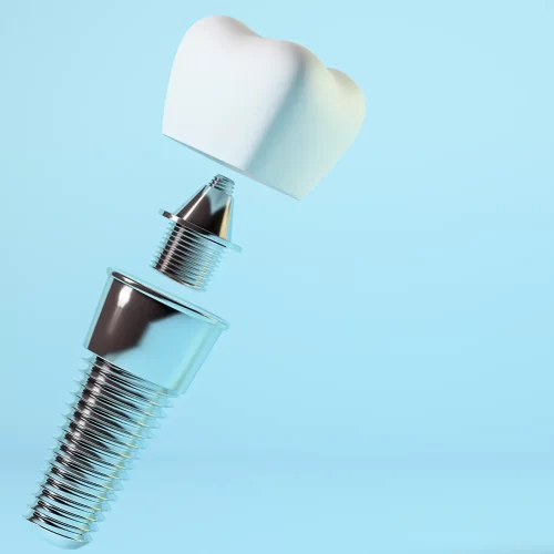 Dental Posts Explained: Types, Procedure, and Benefits