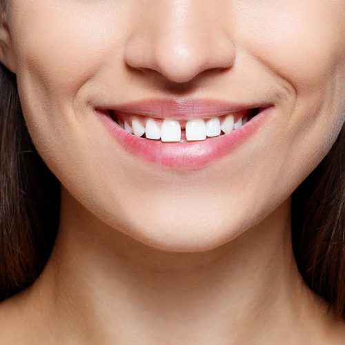 Diastema Demystified: Exploring Causes and Types