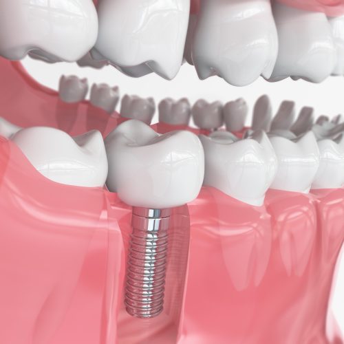 Different Types of Dental Implants: A Comprehensive Guide