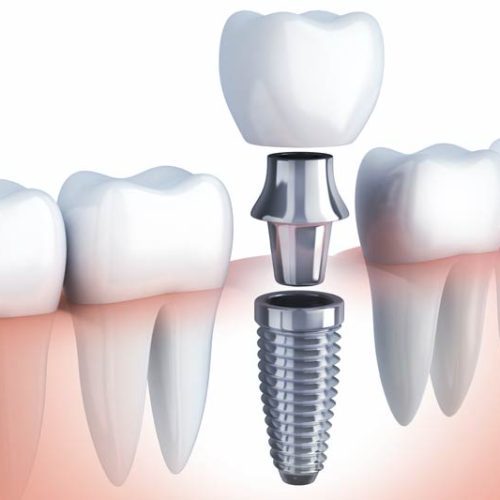 Different Types of Dental Implants: Advantages & Disadvantages
