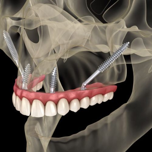 Digital image showing zygomatic implants