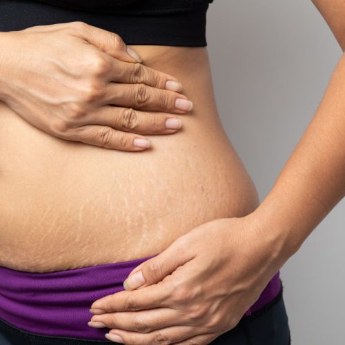 Does a Tummy Tuck Get Rid of Stretch Marks?