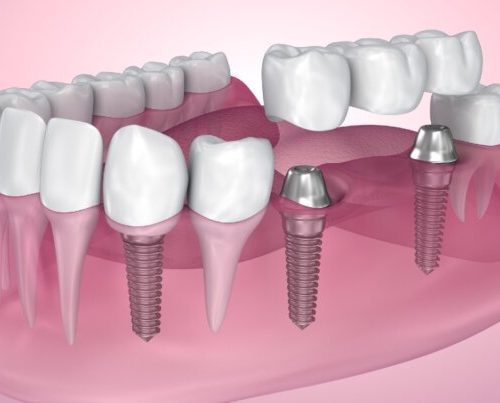 Everything You Need to Know About Dental Implant Bridges