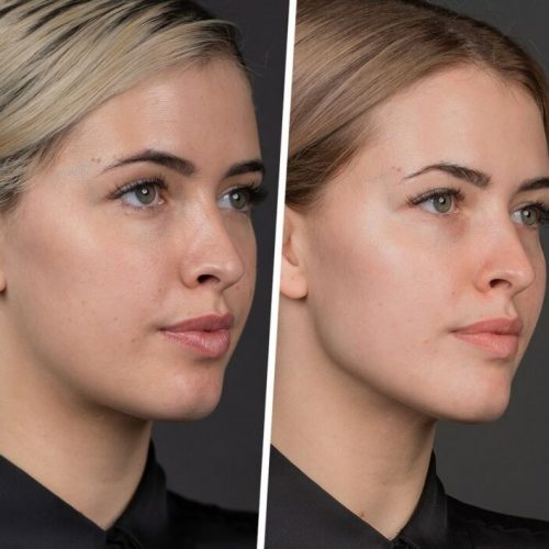 Forehead Contouring Surgery: Reshape Your Facial Features