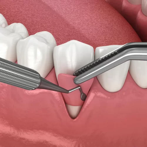 Gum Graft Surgery: Types and Recovery Insights