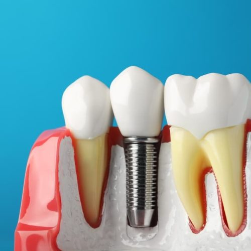 How Long Does the Dental Implant Process Take? A Comprehensive Guide