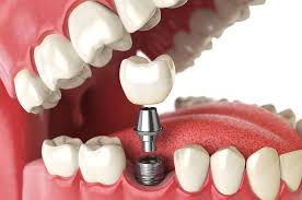 How Soon After Tooth Extraction Can You Get Dental Implants?