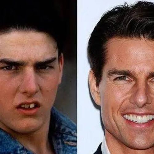 How the Hollywood Smile Procedure Transformed Tom Cruise’s Teeth