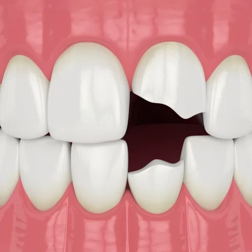 How to Fix a Chipped Front Tooth: Effective Solutions for Repairing